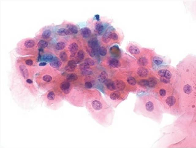 【学术前沿】细胞学为低度鳞状上皮内病变的管理-低度鳞状上皮内病变的治疗