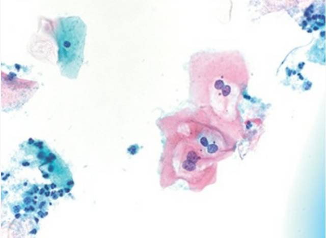 【学术前沿】细胞学为低度鳞状上皮内病变的管理-低度鳞状上皮内病变的治疗