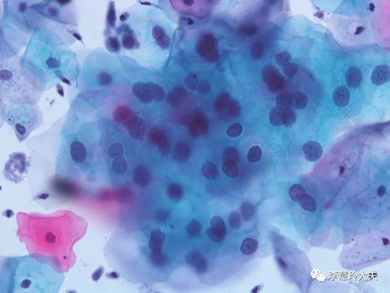 【宫颈病变百问】低度鳞状上皮内病变（LSIL）是什么含义，如何处理？-宫颈tct:宫颈低度鳞状上皮内病变(lsil)