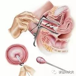 【宫颈病变百问】低度鳞状上皮内病变（LSIL）是什么含义，如何处理？-宫颈tct:宫颈低度鳞状上皮内病变(lsil)