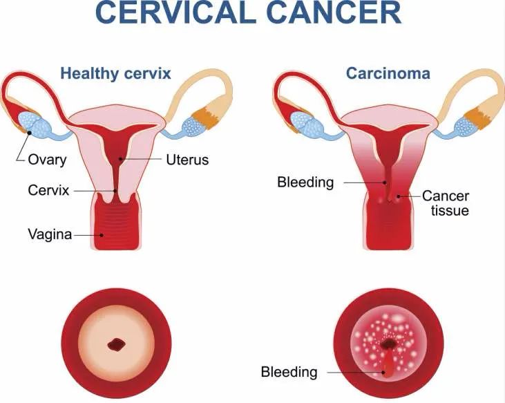 看完了你就知道什么是宫颈癌前变-啥是宫颈癌前病变