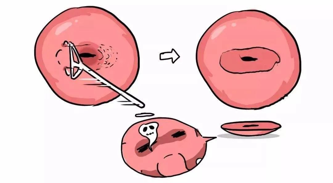 看完了你就知道什么是宫颈癌前变-啥是宫颈癌前病变