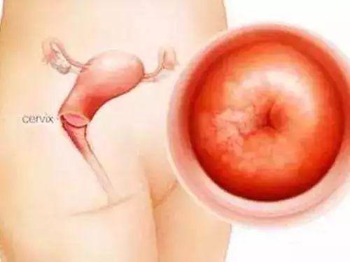 宫颈的低级和高级鳞状上皮内病变的区别-高级别鳞状上皮内低度病变什么意思