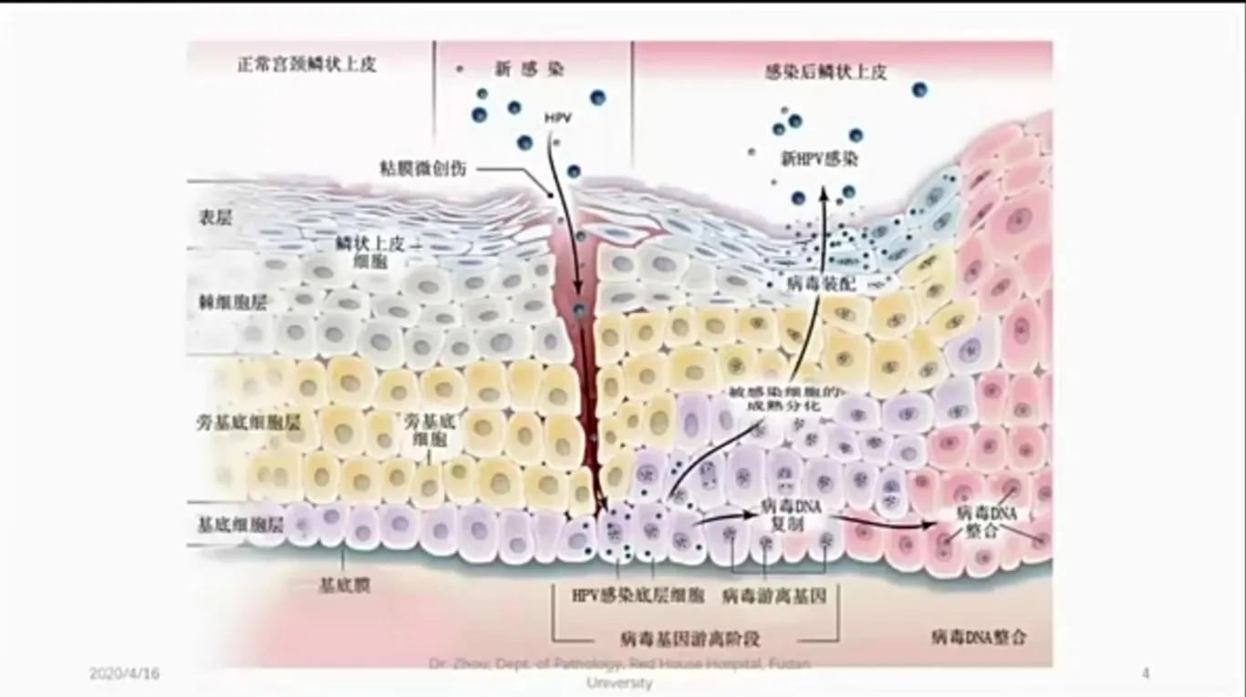 宫颈鳞状上皮低级别上皮内病变（LSIL），不应该过度治疗-宫颈上皮鳞状低度病变是宫颈癌吗严重吗