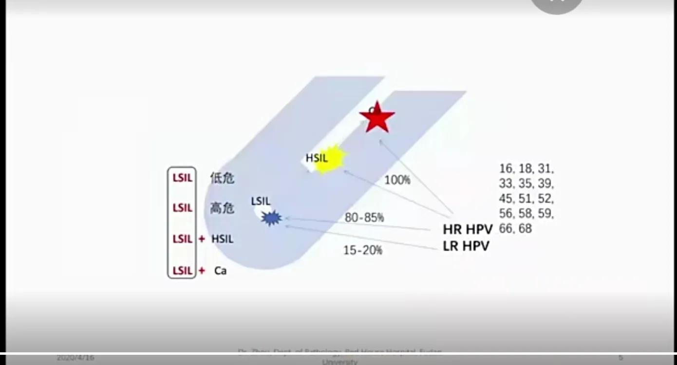宫颈鳞状上皮低级别上皮内病变（LSIL），不应该过度治疗-宫颈上皮鳞状低度病变是宫颈癌吗严重吗