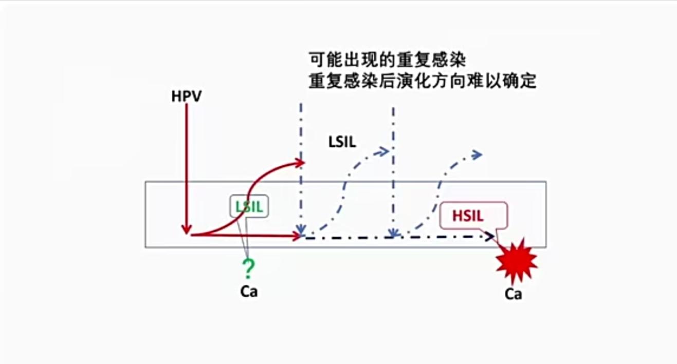宫颈鳞状上皮低级别上皮内病变（LSIL），不应该过度治疗-宫颈上皮鳞状低度病变是宫颈癌吗严重吗