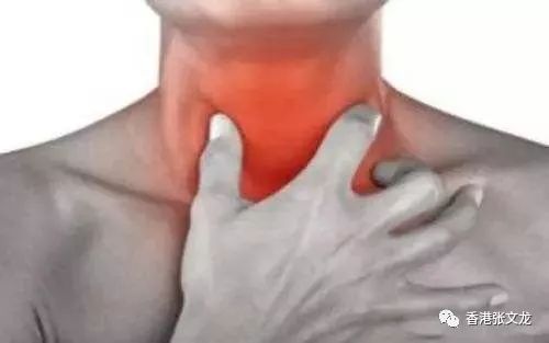 一文读懂:食管鳞状细胞癌——世界最常见的食管癌疾病-食管鳞状细胞癌临床表现是什么