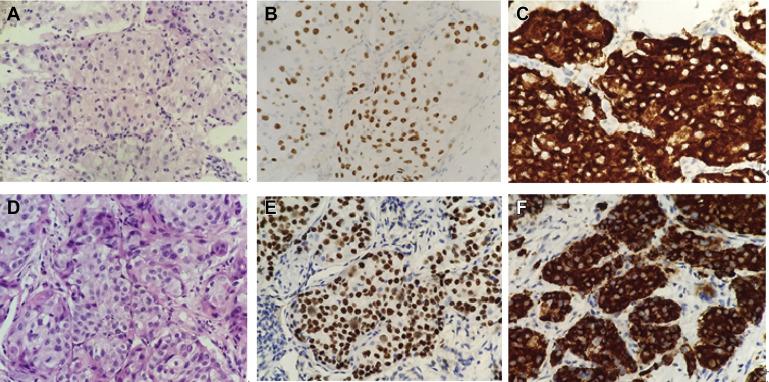 克唑替尼治疗ALK和ROS1双重排肺鳞状细胞癌病例报告-克唑替尼的功效与副作用