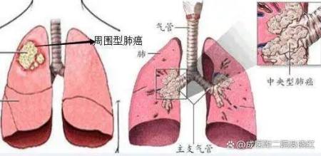 确诊肺癌，需要做哪些检查？-肺癌确诊都需要做什么检查