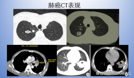 确诊肺癌，需要做哪些检查？-肺癌确诊都需要做什么检查