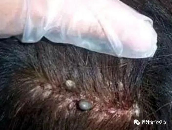 1980年代那些臭虫、虱子、跳蚤们-80后小时候的