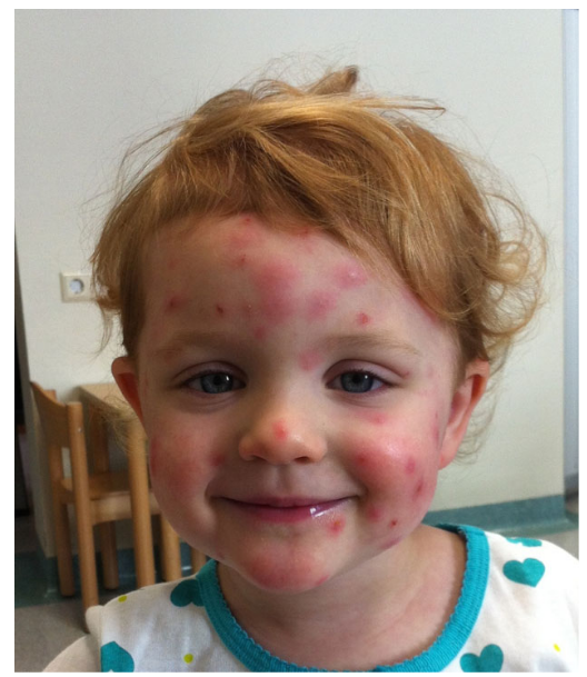 万物复苏，孩子身上起皮疹，你一定要看看这篇！-孩子身上皮疹怎么回事