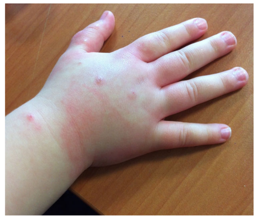 万物复苏，孩子身上起皮疹，你一定要看看这篇！-孩子身上皮疹怎么回事