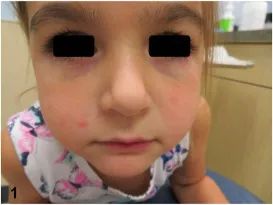 万物复苏，孩子身上起皮疹，你一定要看看这篇！-孩子身上皮疹怎么回事