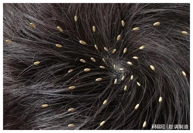 为何小时候大多数人都会长的“虱子”，现在都不见了？今天知道了-为什么小时候头上长虱子长大了不长