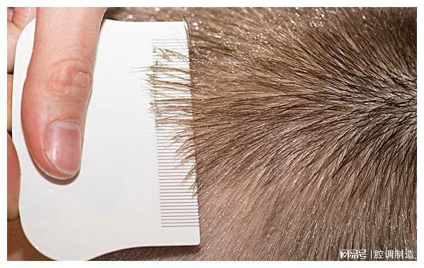 为何小时候大多数人都会长的“虱子”，现在都不见了？今天知道了-为什么小时候头上长虱子长大了不长