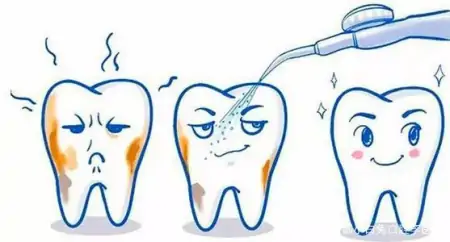 一篇关于洗牙的科普小文，看你知道多少洗牙的知识-洗牙的基本要点