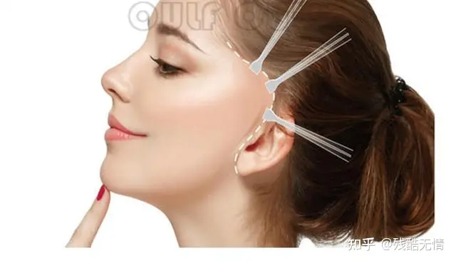 深度科普：筋膜悬吊提升术是什么、筋膜提拉一般多少钱~-筋膜悬吊是拉皮吗