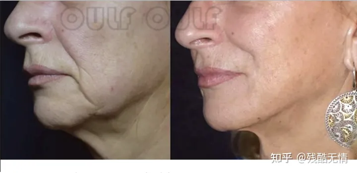 深度科普：筋膜悬吊提升术是什么、筋膜提拉一般多少钱~-筋膜悬吊是拉皮吗