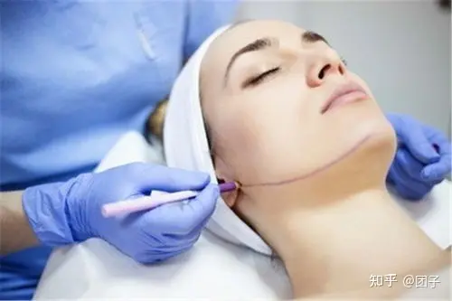 调查：筋膜悬吊面部提升术保持多久？筋膜提拉一般多少钱-筋膜悬吊术是拉皮吗