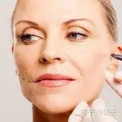 调查：筋膜悬吊面部提升术保持多久？筋膜提拉一般多少钱-筋膜悬吊术是拉皮吗