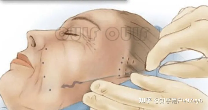 筋膜提拉术手术全过程，筋膜提升恢复期多长时间~-筋膜提拉术到底好不好