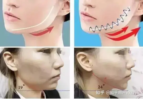 筋膜提拉术手术全过程，筋膜提升恢复期多长时间~-筋膜提拉术到底好不好