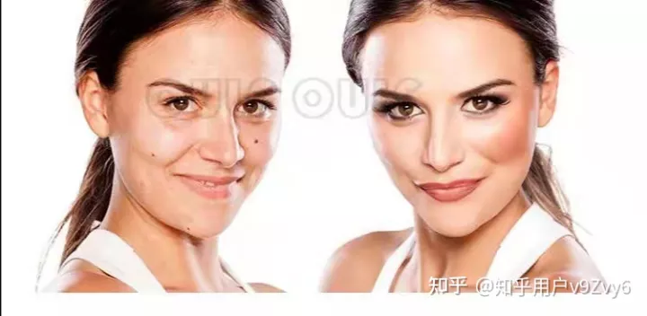 筋膜提拉术手术全过程，筋膜提升恢复期多长时间~-筋膜提拉术到底好不好