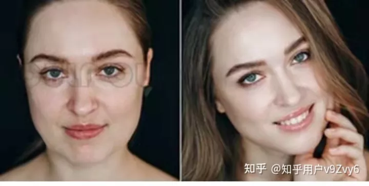 筋膜提拉术手术全过程，筋膜提升恢复期多长时间~-筋膜提拉术到底好不好