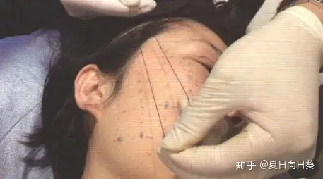 如果你不知道埋线提拉多少钱，千万别尝试！-埋线提拉的危害