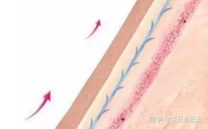 如果你不知道埋线提拉多少钱，千万别尝试！-埋线提拉的危害