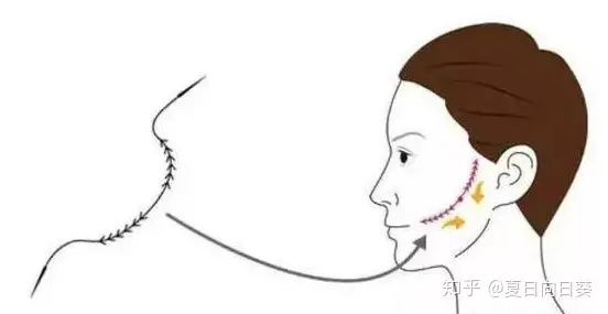 如果你不知道埋线提拉多少钱，千万别尝试！-埋线提拉的危害