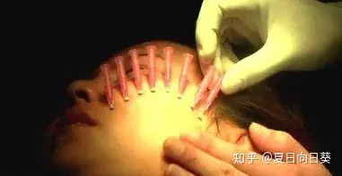 如果你不知道埋线提拉多少钱，千万别尝试！-埋线提拉的危害