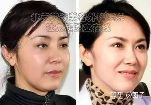 筋膜悬吊面部提升术后悔死了？筋膜悬吊面部提升术原理-无痕筋膜提升术多少钱