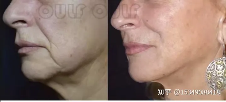 7d聚拉提做一次多少钱价格，7d聚拉提做一次维持多久~-7d聚拉提做一次维持多长时间