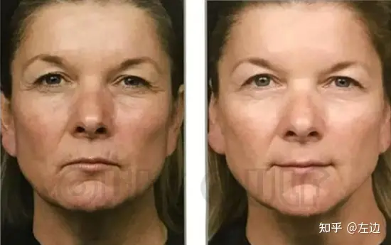 筋膜提升术是什么、筋膜提升拉皮手术维持多久-筋膜提拉手法