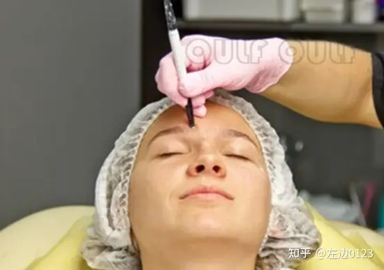 筋膜悬吊术、筋膜悬吊提升术是什么-筋膜悬吊术,筋膜悬吊提升术是什么手术