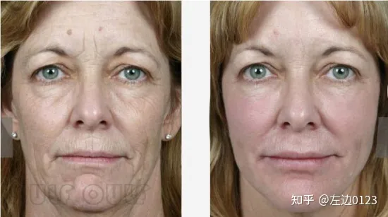 筋膜悬吊术、筋膜悬吊提升术是什么-筋膜悬吊术,筋膜悬吊提升术是什么手术