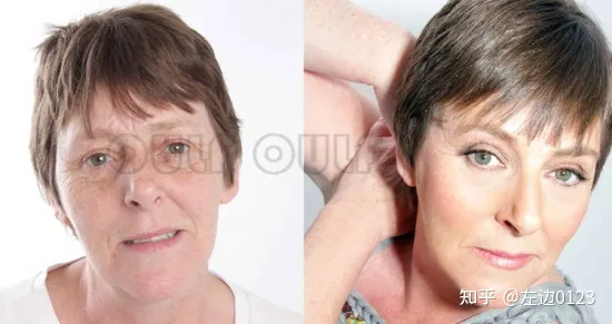 筋膜悬吊术、筋膜悬吊提升术是什么-筋膜悬吊术,筋膜悬吊提升术是什么手术