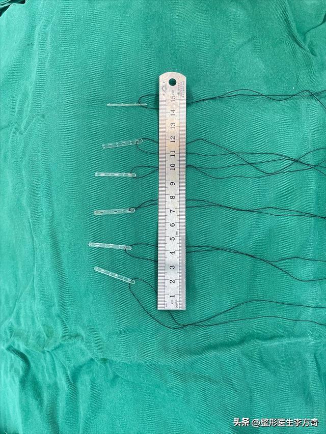 花1万多做线雕被坑又做了提拉带提升才明白什么叫真正的筋膜悬吊-做线雕提拉紧致要多少钱?