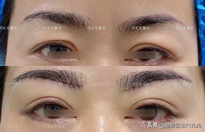 筋膜悬吊提眉手术所能达到的6个效果，准备提眉手术的姐妹了解下-筋膜悬吊提眉术视频