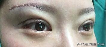 筋膜悬吊提眉手术所能达到的6个效果，准备提眉手术的姐妹了解下-筋膜悬吊提眉术视频