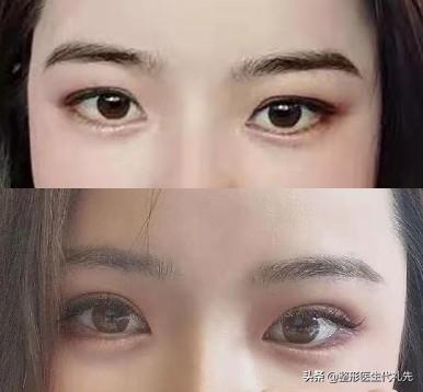 筋膜悬吊提眉手术所能达到的6个效果，准备提眉手术的姐妹了解下-筋膜悬吊提眉术视频