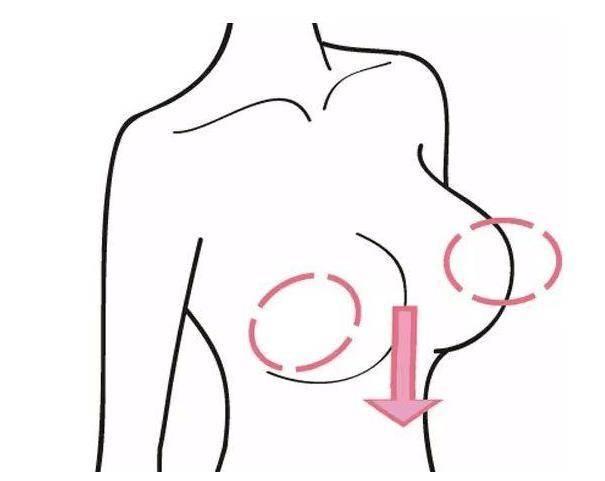 乳房提升手术怎么做？手术需要多少钱？-乳房提升手术后的注意事项