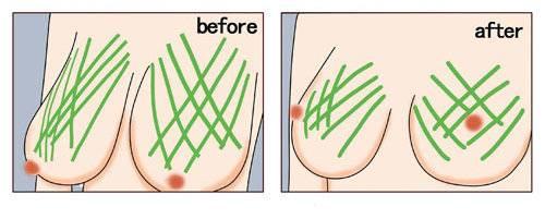 乳房提升手术怎么做？手术需要多少钱？-乳房提升手术后的注意事项