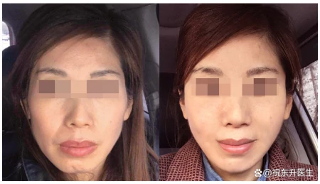 小拉皮提升反馈，恢复34天素颜，术前术后状态对比分析-做小拉皮手术视频