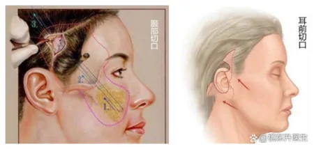 小拉皮提升反馈，恢复34天素颜，术前术后状态对比分析-做小拉皮手术视频