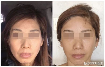 小拉皮提升反馈，恢复34天素颜，术前术后状态对比分析-做小拉皮手术视频