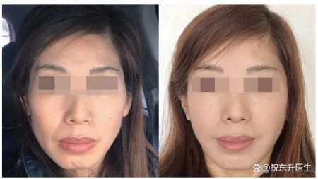 小拉皮提升反馈，恢复34天素颜，术前术后状态对比分析-做小拉皮手术视频