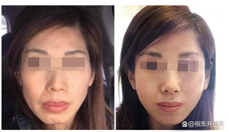 小拉皮提升反馈，恢复34天素颜，术前术后状态对比分析-做小拉皮手术视频